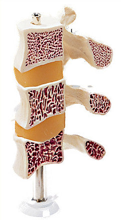 0268-78 Deluxe Osteoporosis Series