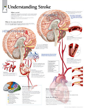 2455-08 Understanding Stroke